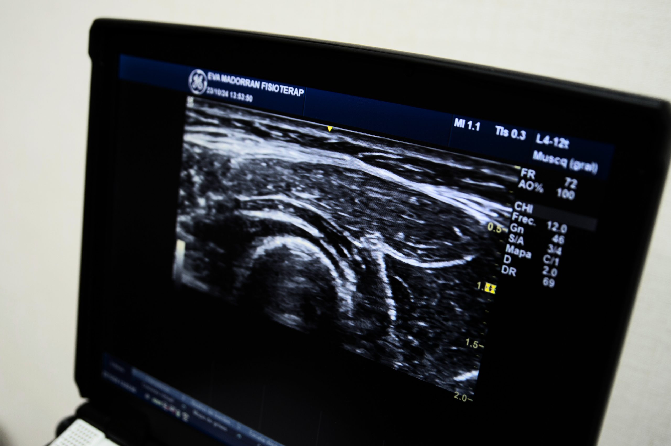 Induccion Miofascial